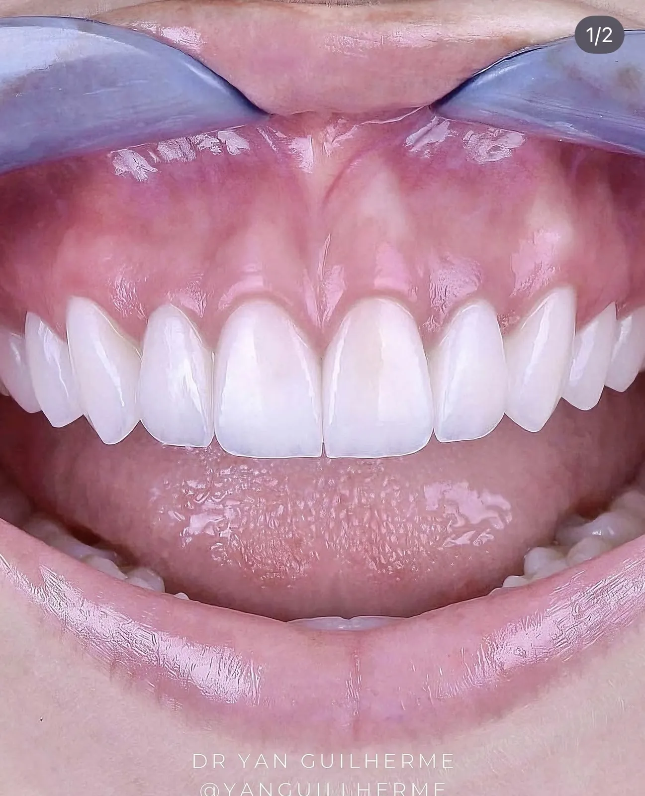 Transformação dental — lentes de porcelana