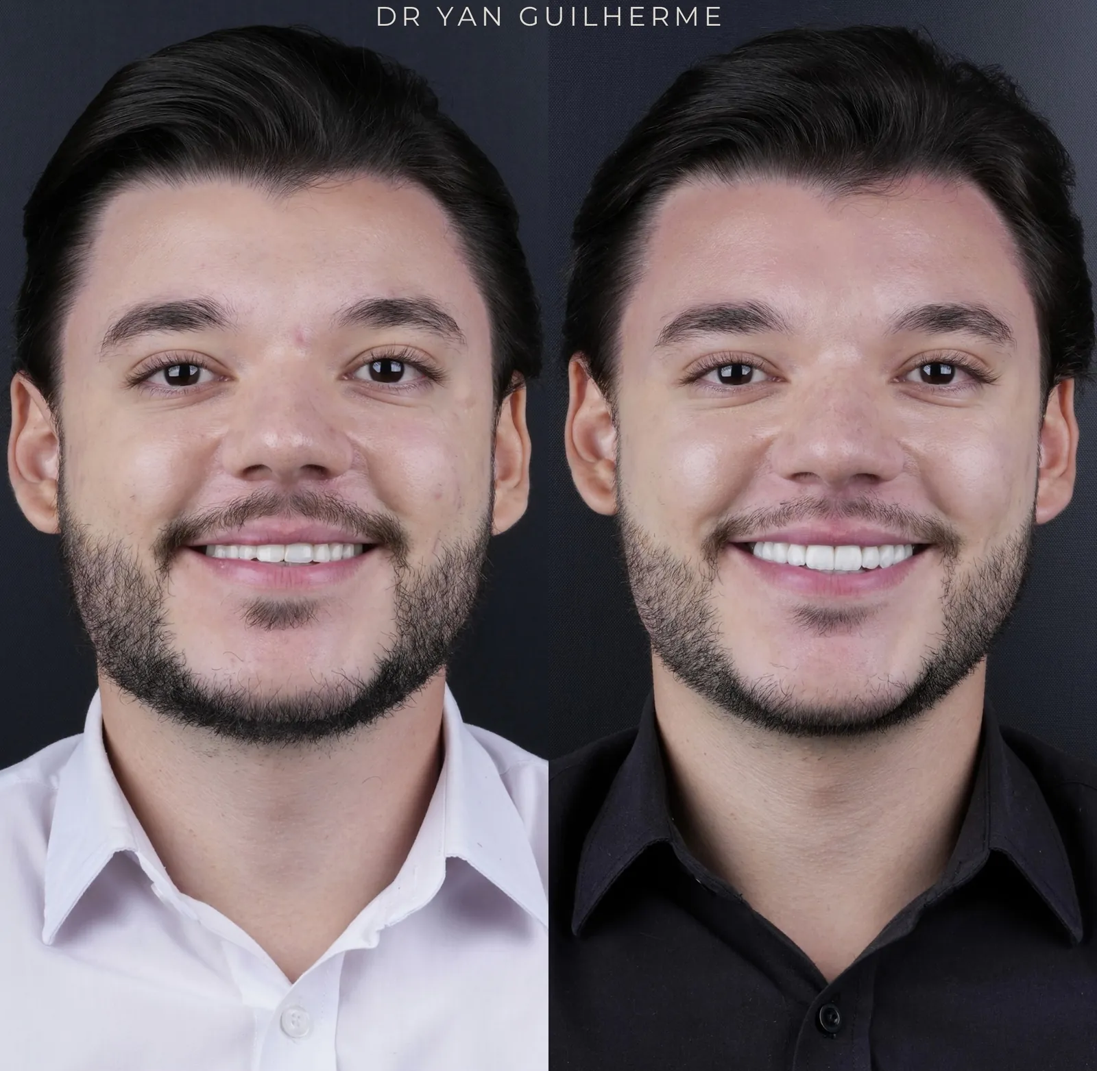 Transformação dental — lentes de porcelana