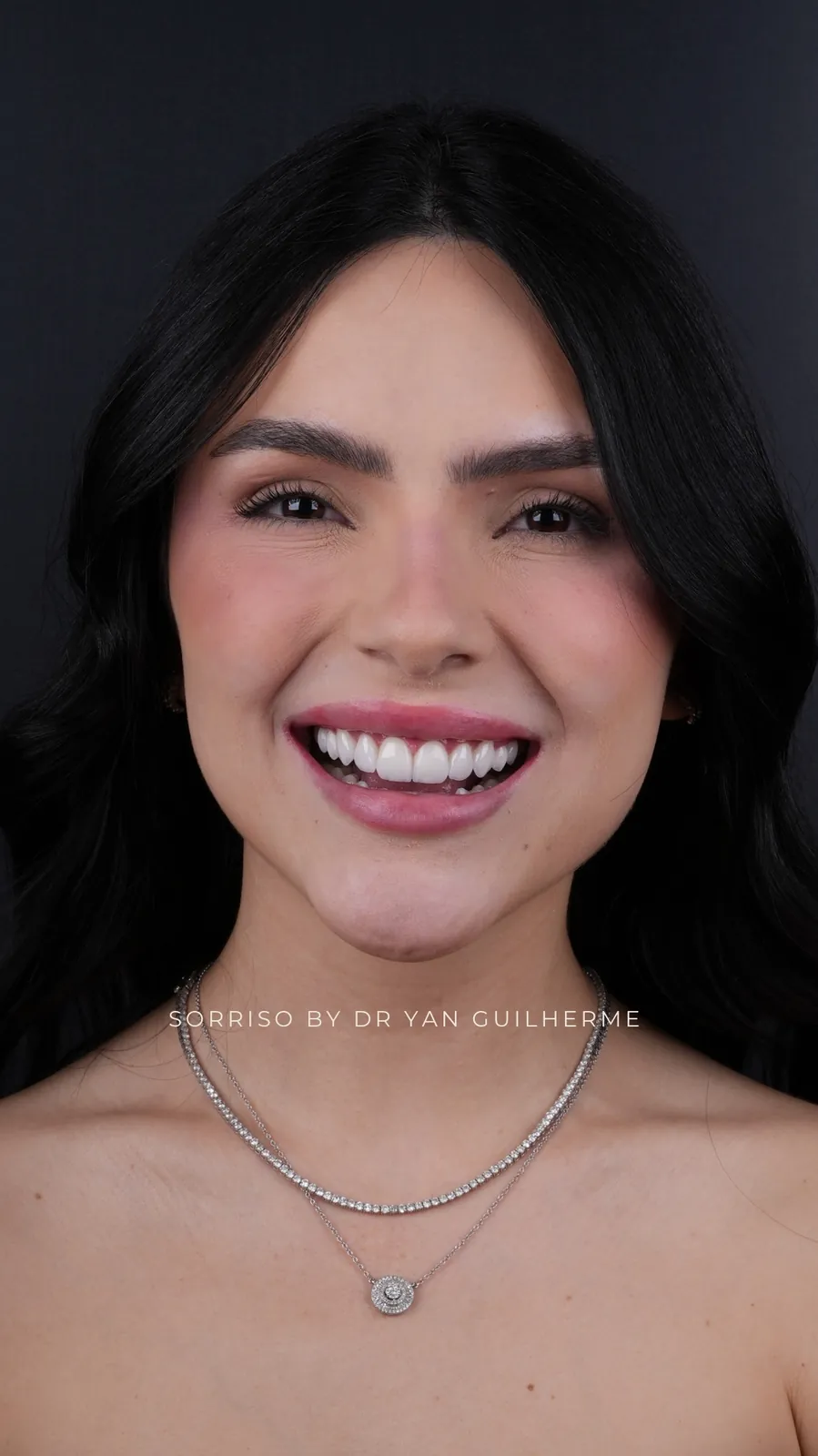 Transformação dental — lentes de porcelana