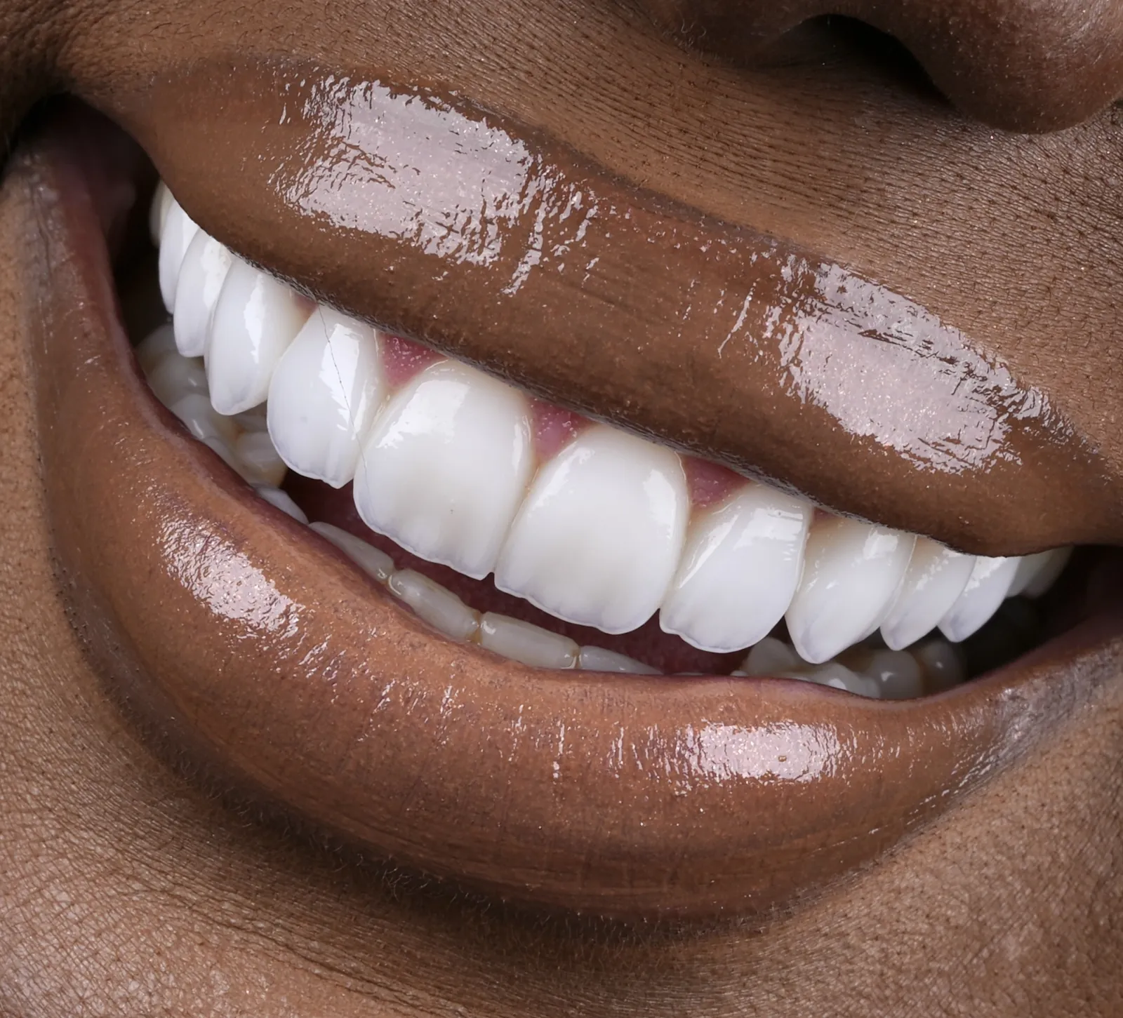 Transformação dental — lentes de porcelana