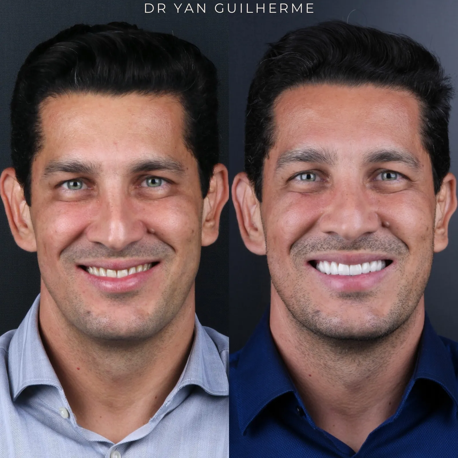 Transformação dental — lentes de porcelana
